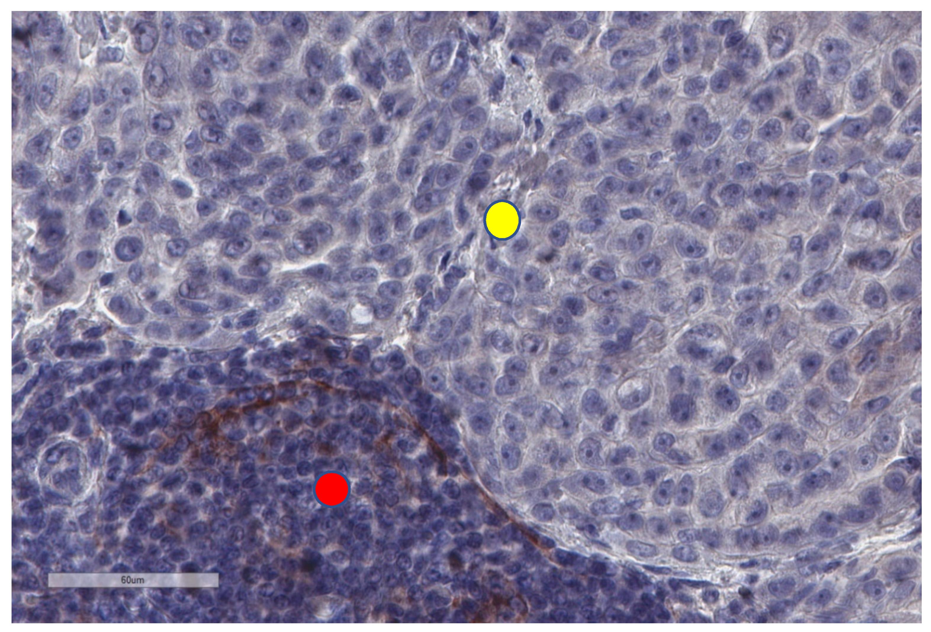 Cancers | Free Full-Text | The Immune Microenvironment of ...